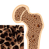 Osteoporose 2